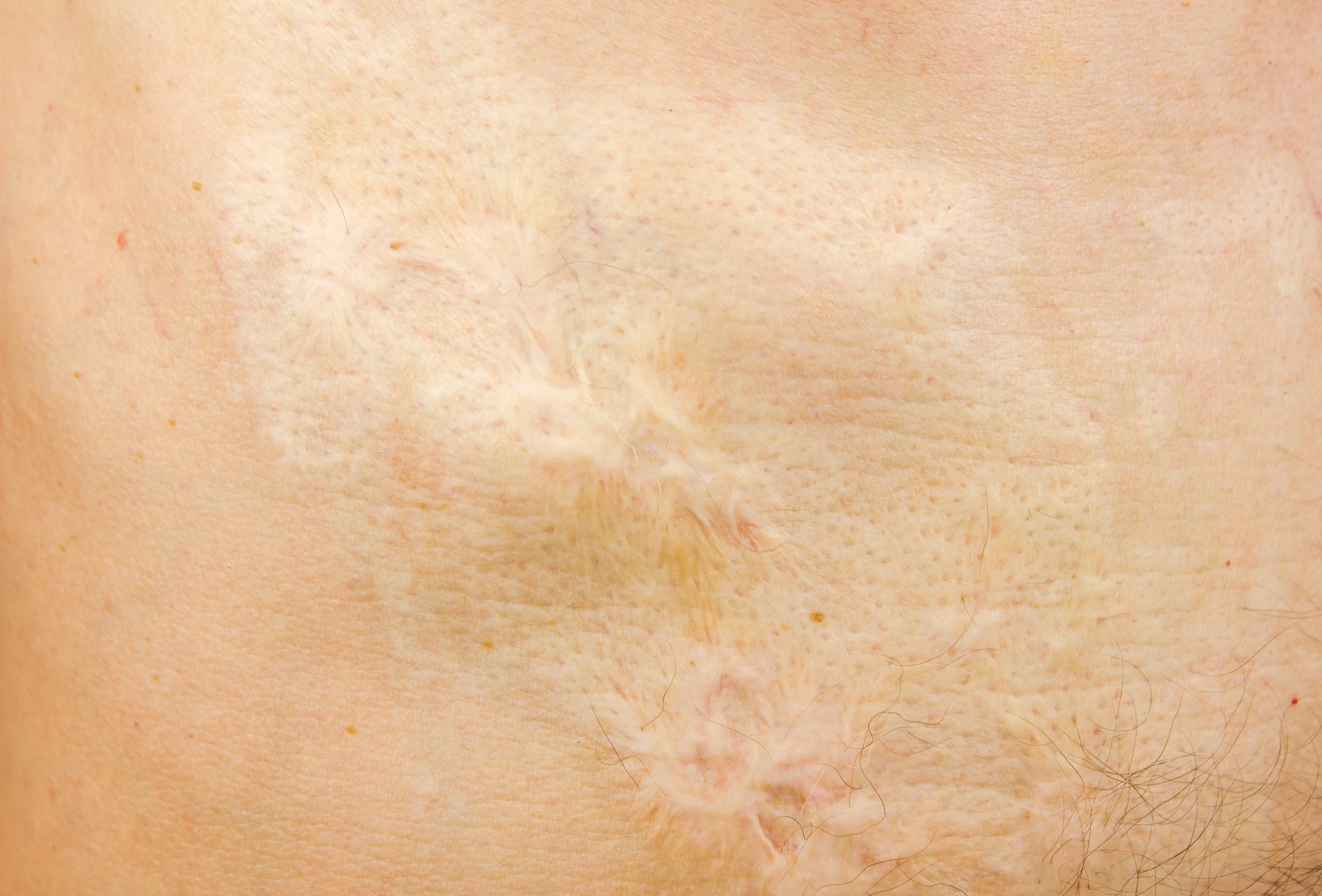 Tissue damage considerations in alcohol disinfecting wounds