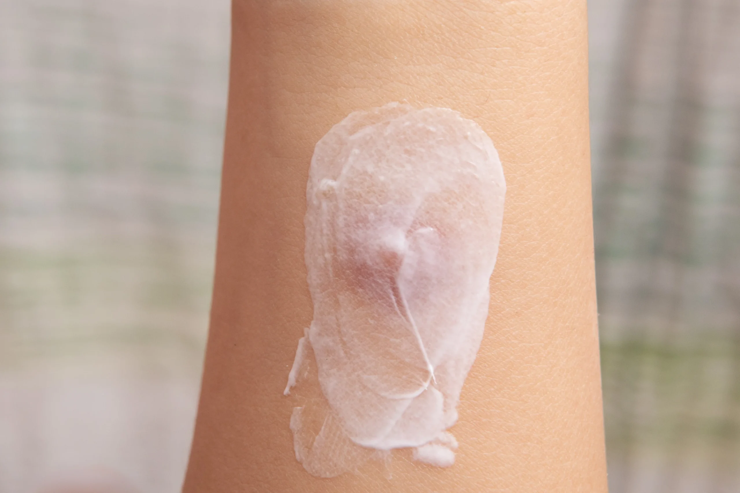 Treating painful insect bites with topical creams