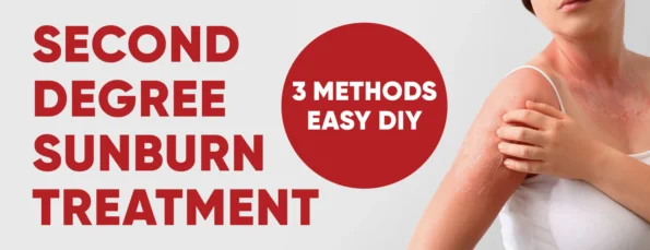 Treating sunburns of the second degree