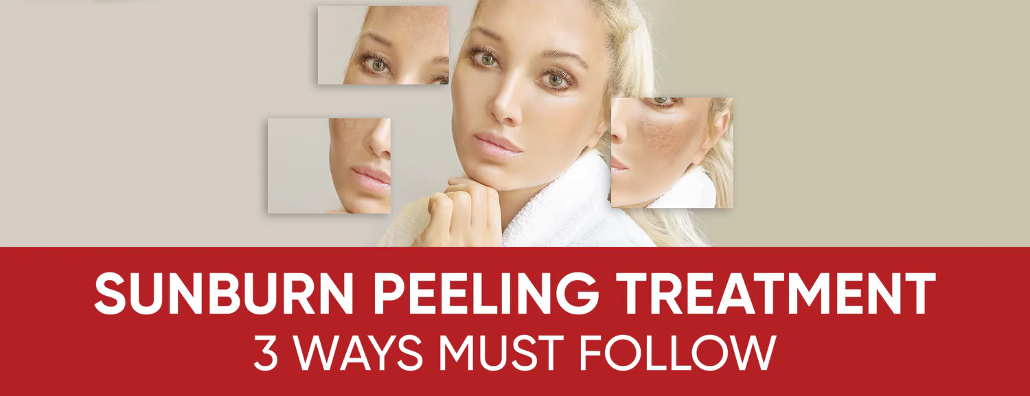 Treatment for sunburn peeling