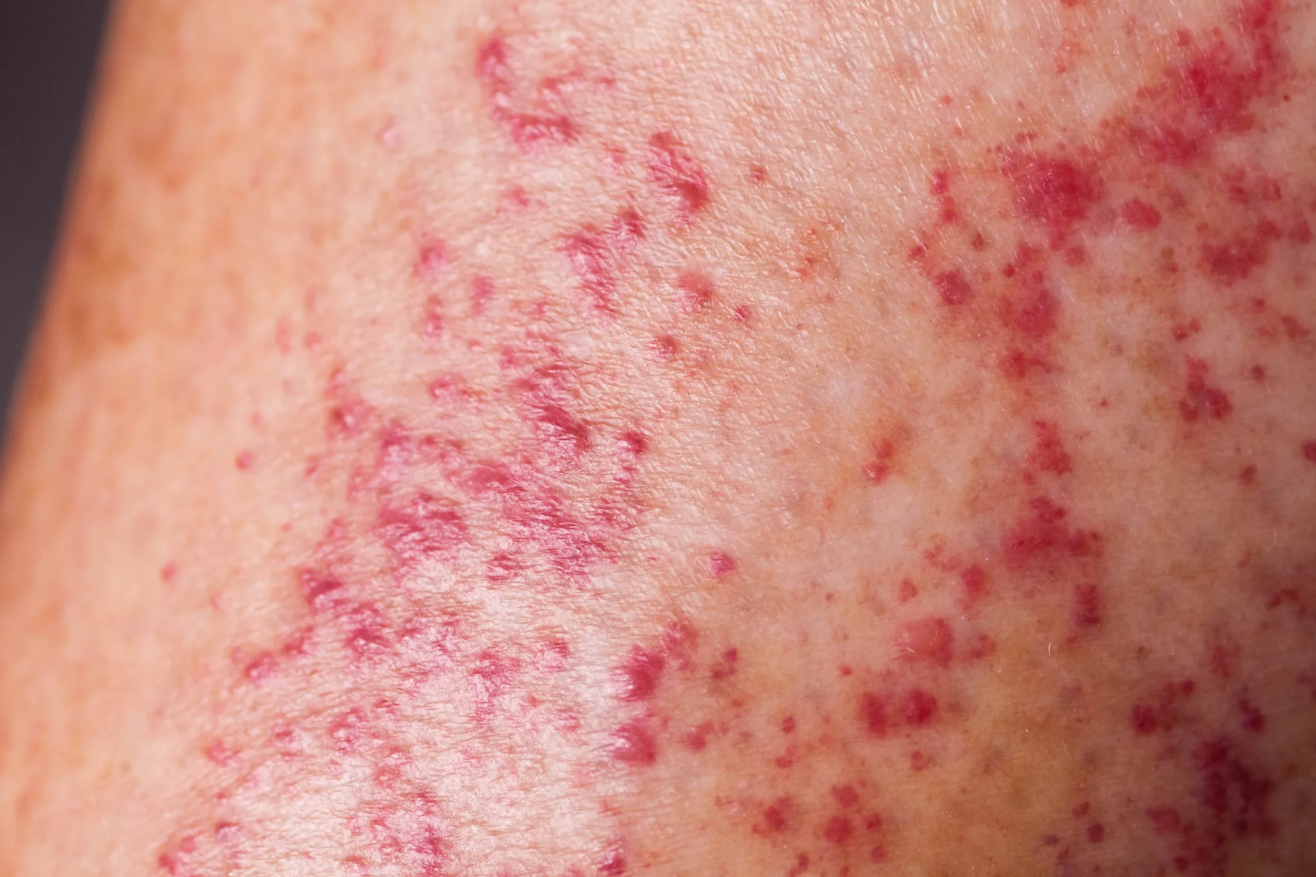 Types of Polymorphic Light Eruption (PLE) in Sun Rash