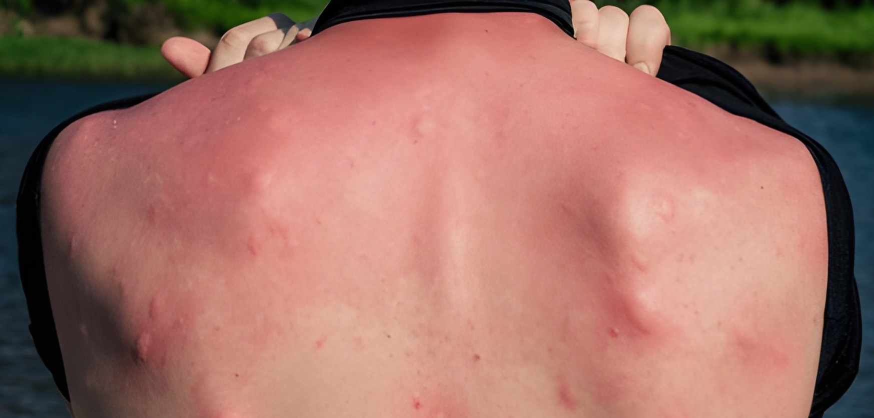 Understanding the causes of insect bites that cause muscle pain