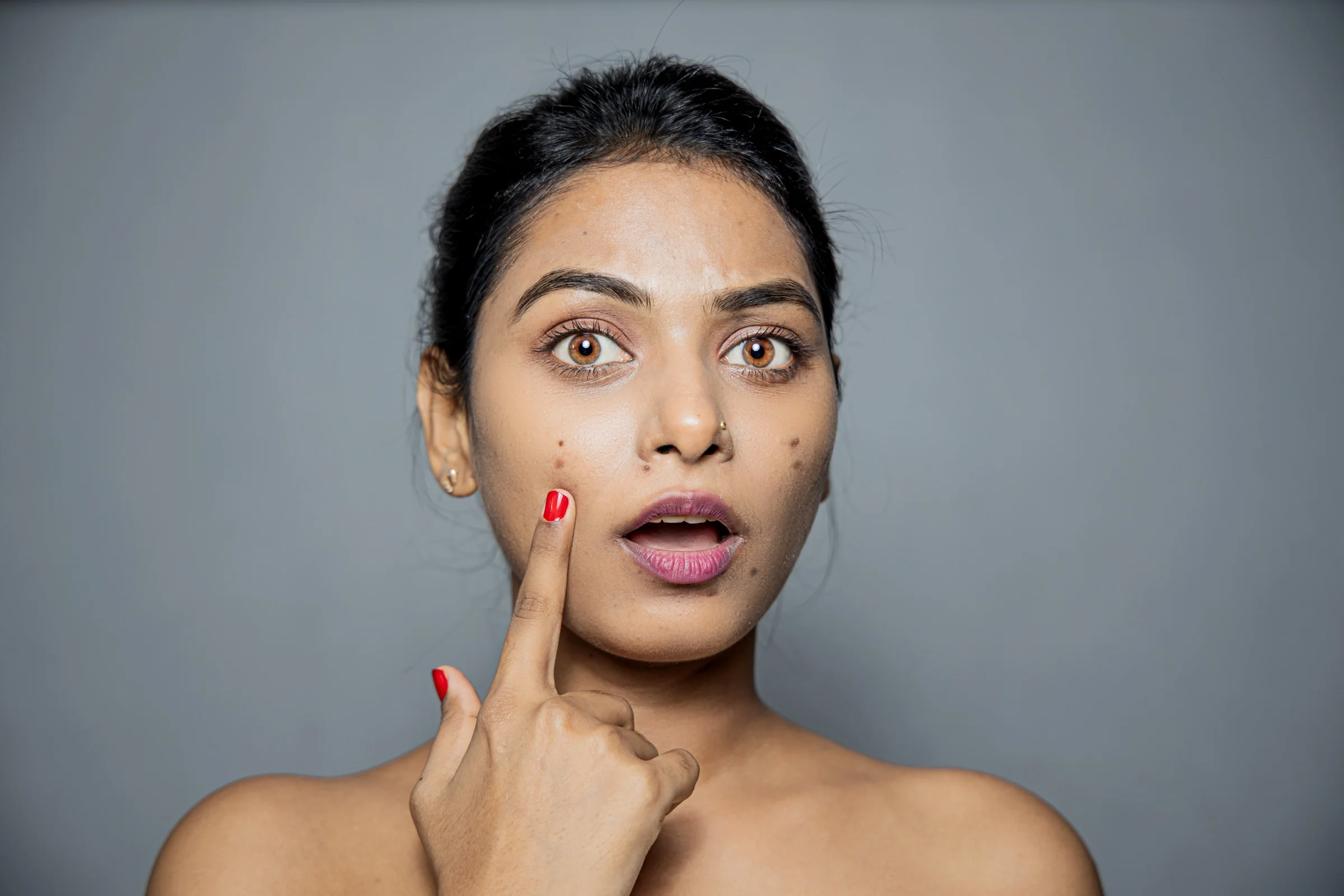 does laser hair removal help with dark spots