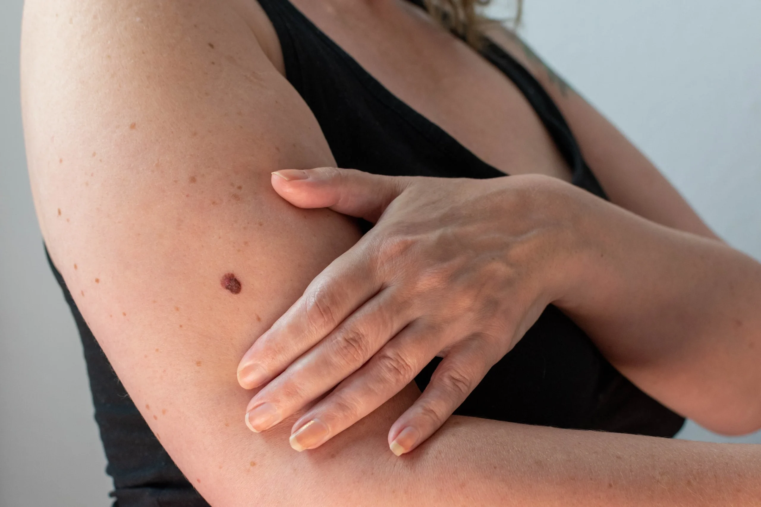 5 Benefits Of Mole Removal Naturally