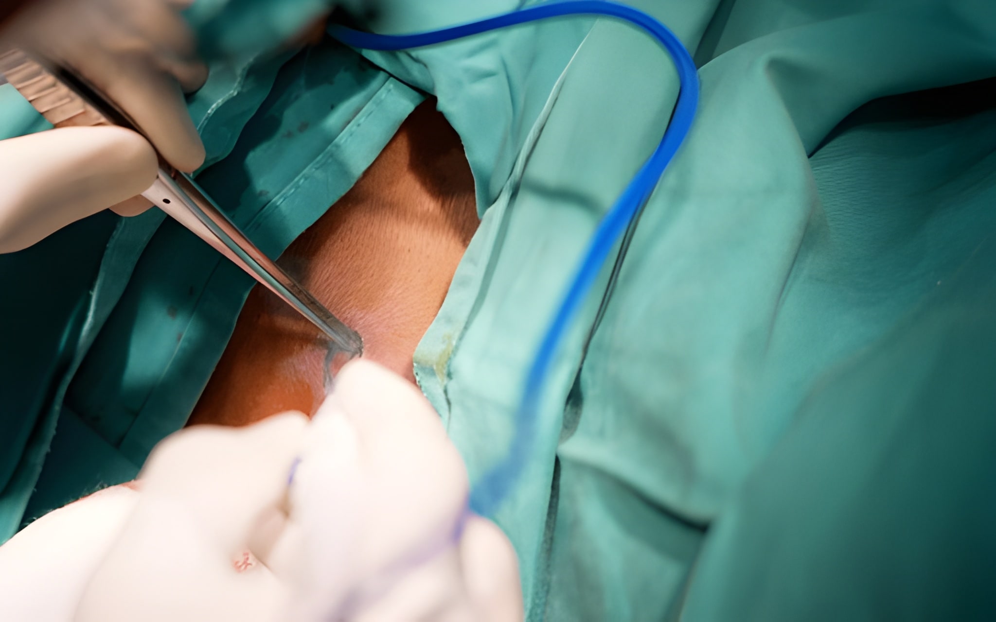 8 Tips to Prevent Depression After Minor Surgery