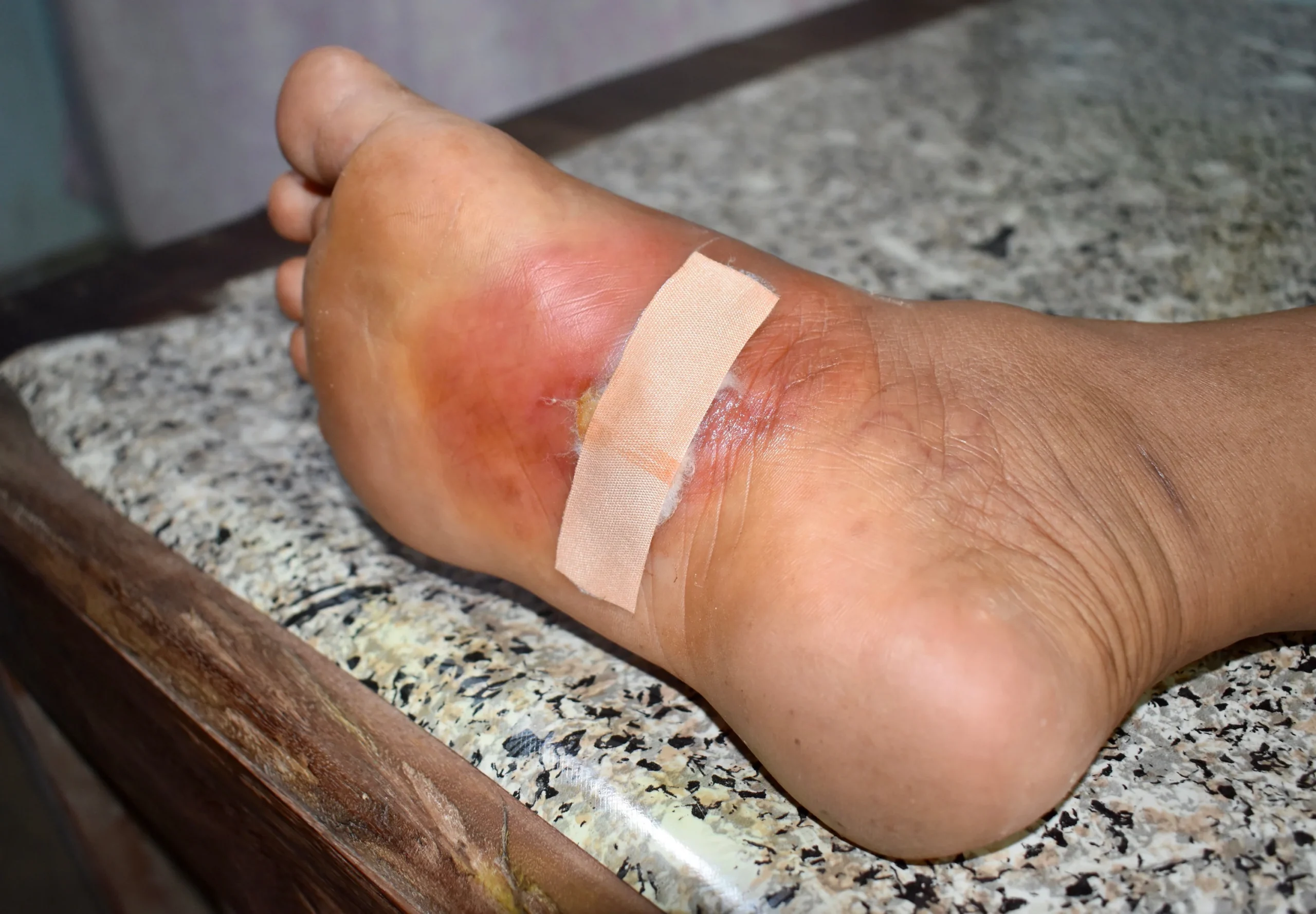 Factors Affecting Wound Healing in Diabetes