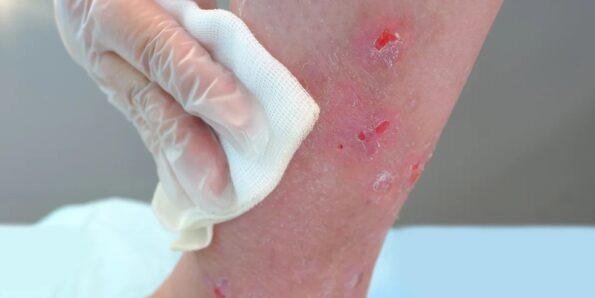 Factors & complications diabetes affect wound healing