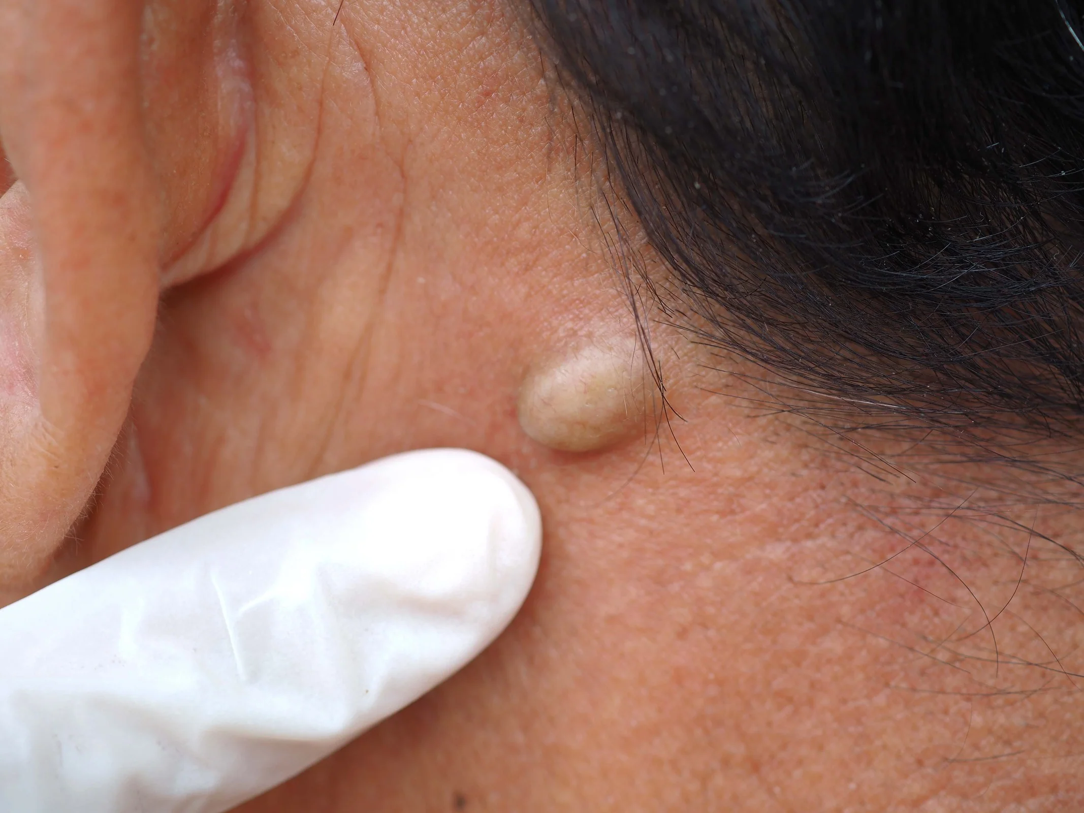 Growing or uncomfortable cysts are indications of cyst removal