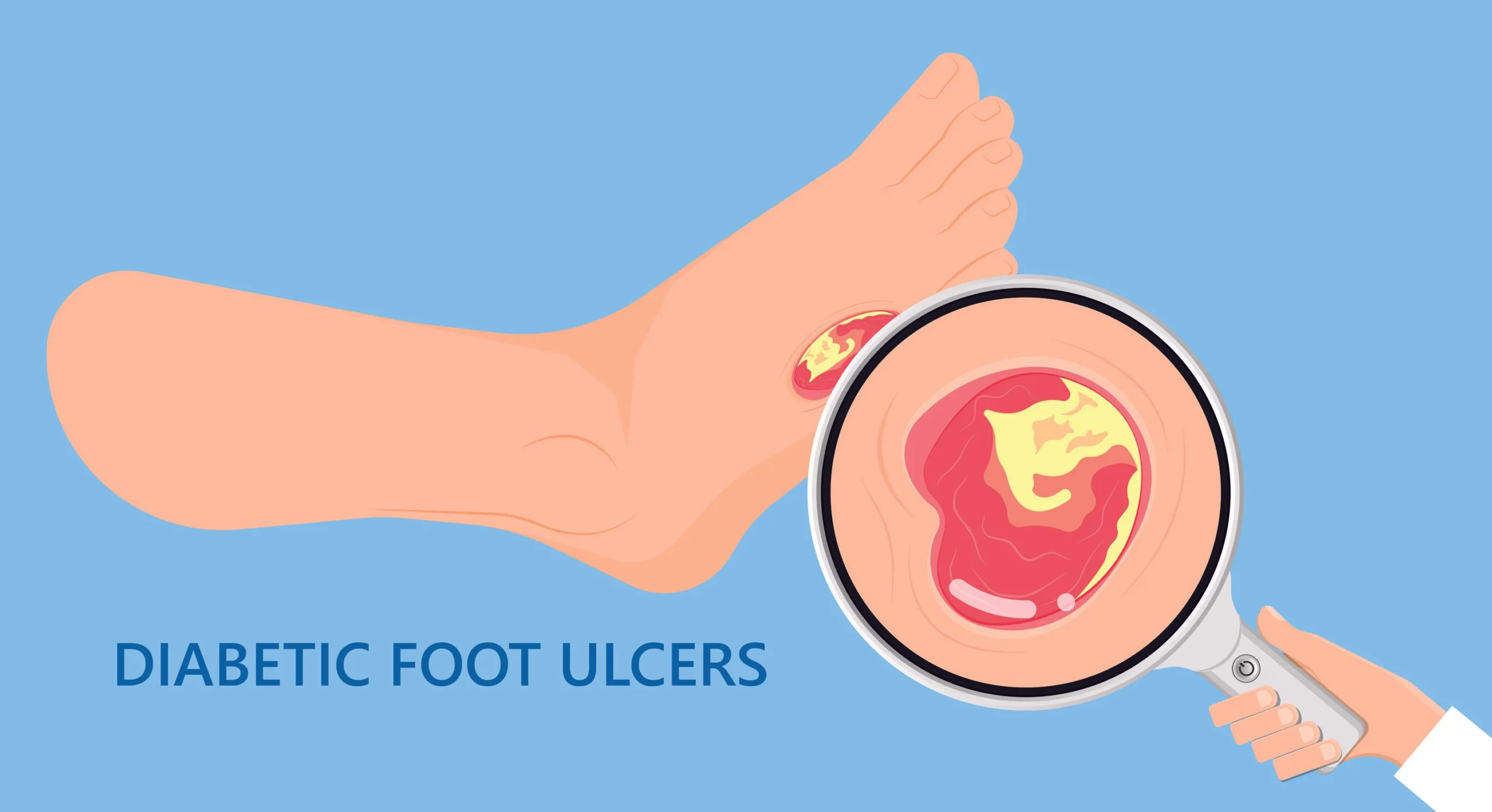 How diabetic foot wounds can be treated