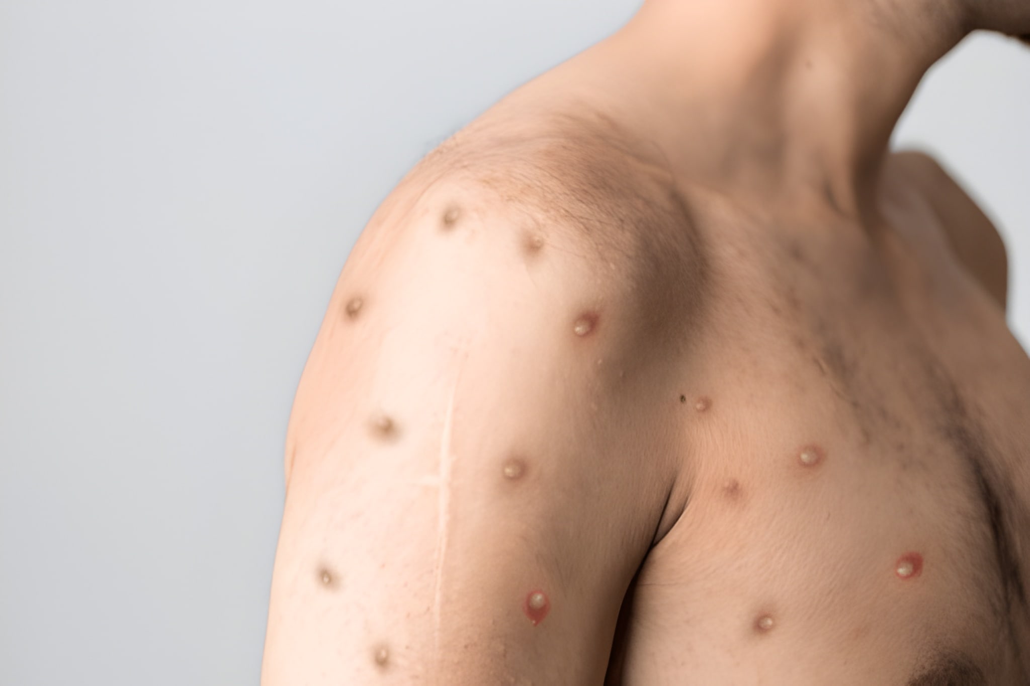Mechanisms of monkeypox natural immunity
