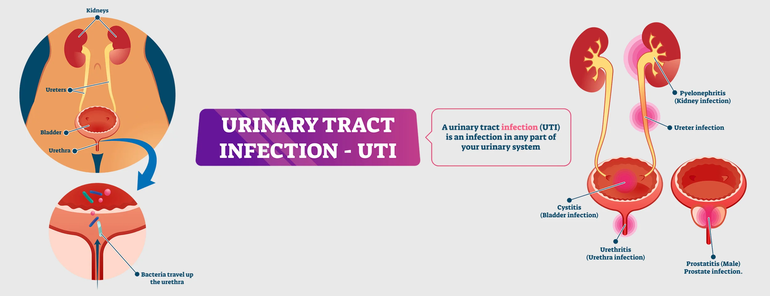 Missing an insulin shot can lead to UTIs in diabetics
