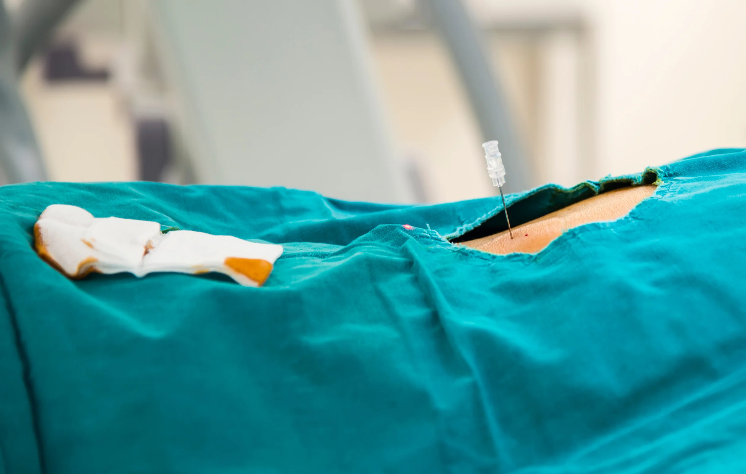 Pain treatment after epidural steroid injections