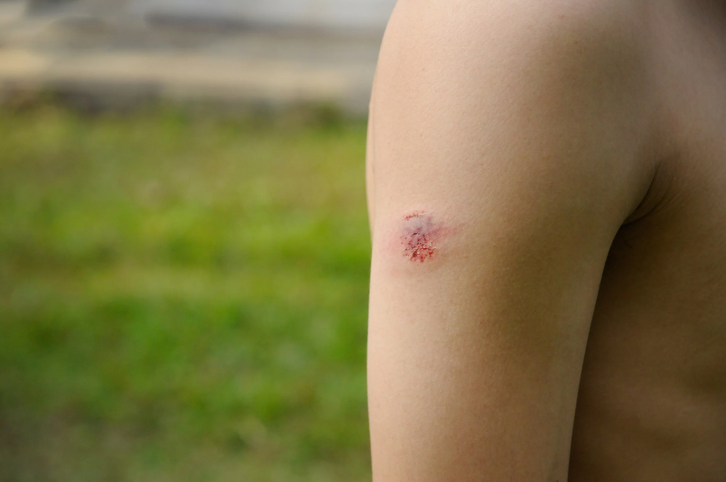 Restrictions on moisture wound healing