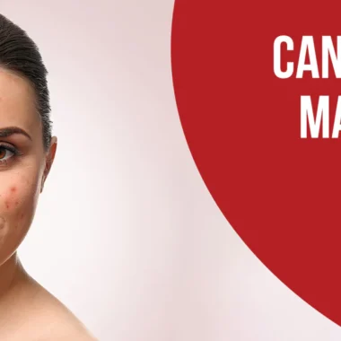 How Do You Get Rid of Beauty Marks: 9 Remedies [Natural]