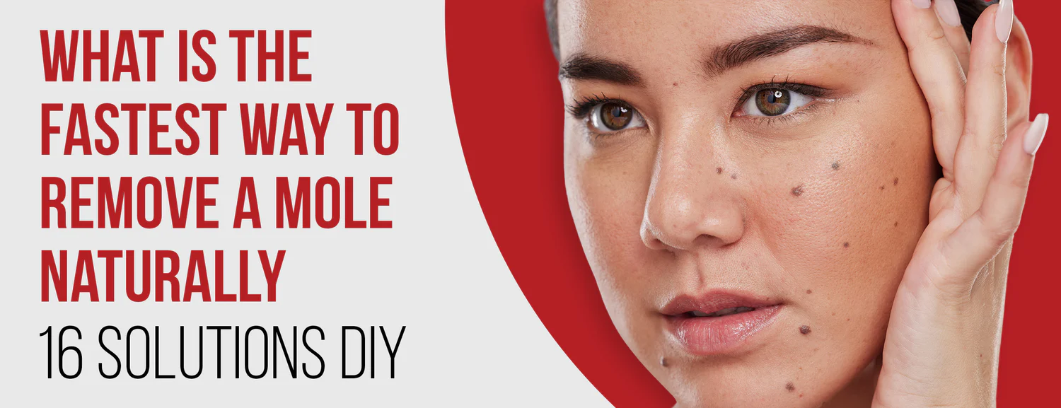 The 16 Best Fastest Way To Remove A Mole Naturally