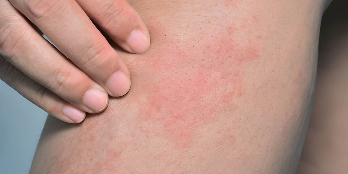 6 common symptoms of food allergy-induced itchy skin
