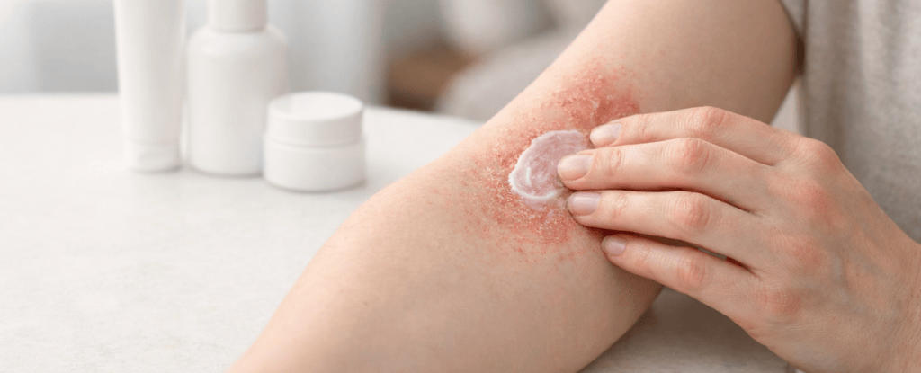 How To Get Rid Contact Dermatitis Fast