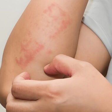 Can Menopause Cause Skin Allergies: 4 Causes [Explained in Steps]