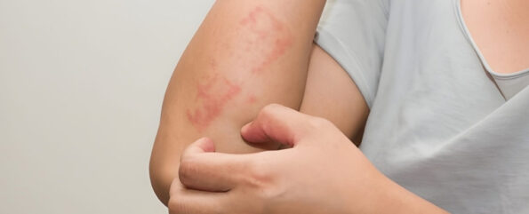 Identifying and preventing skin allergies caused by vitamin deficiency