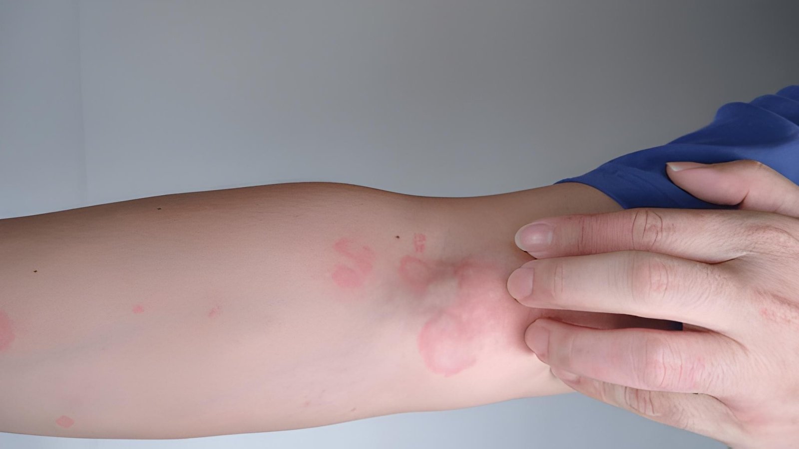 Precautions to Consider When Using Allergy Ointments