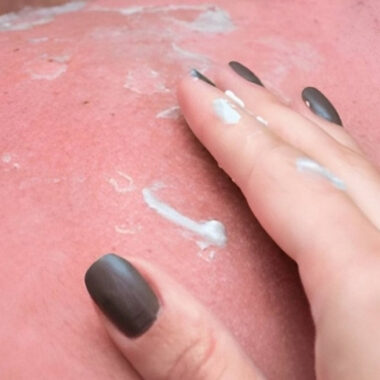 Can Menopause Cause Skin Allergies: 4 Causes [Explained in Steps]