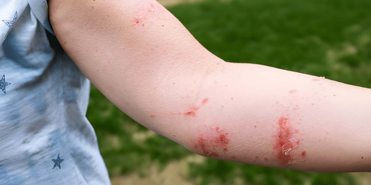 Rashes and blisters caused by plants