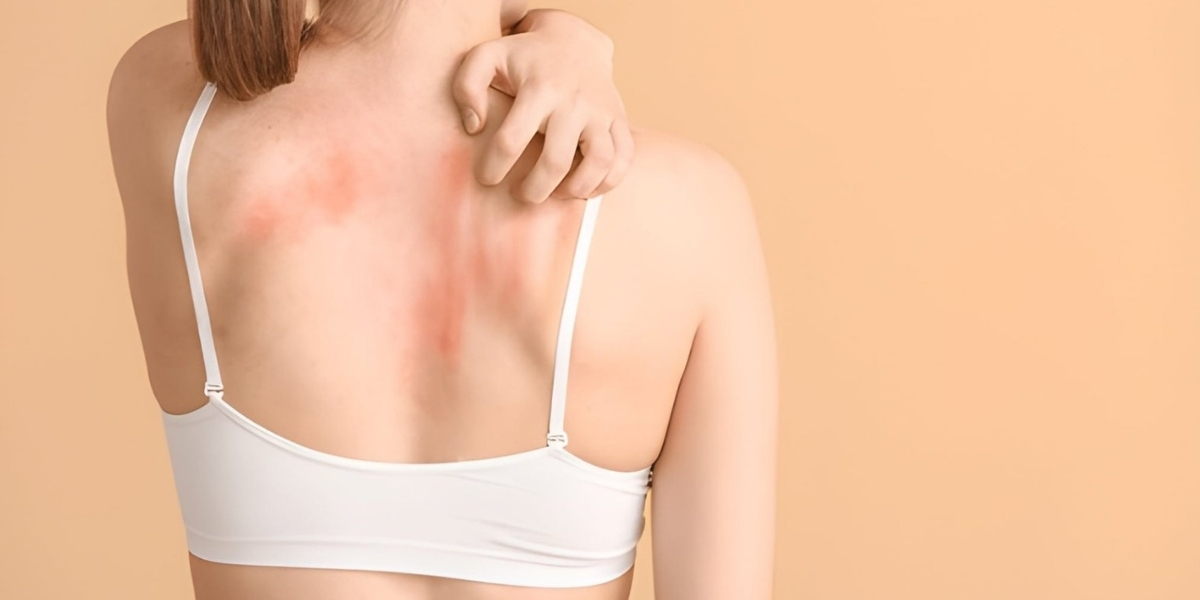 Signs and Symptoms of Skin Allergies