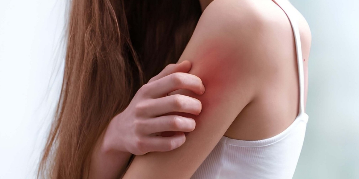 Skin Allergy Preventive Role of Vitamins