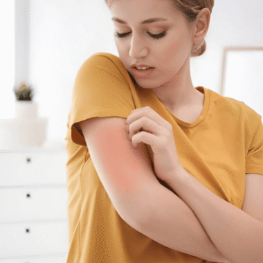 Can You Be Allergic to Cold Weather: 5 Factors & Management [DIY]